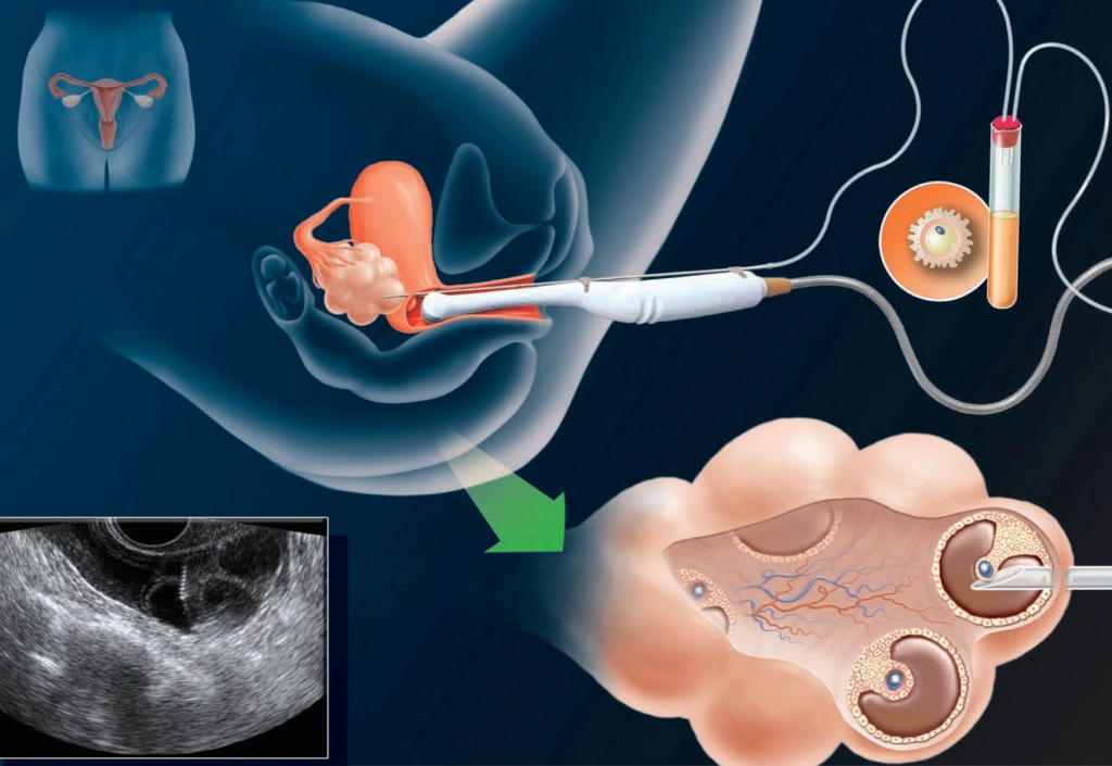 A Step By Step Guide For Egg Donors Eggceptional Donor Group a-step-by-step-guide-for-egg-donors-eggceptional-donor-group